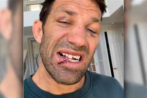 Luke Rockhold shows off chipped teeth after TKO loss