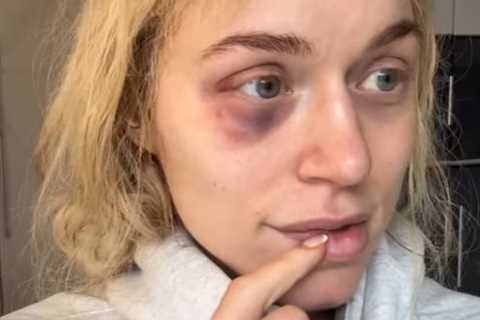 OnlyFans Star Elle Brooke Shows Off Nasty Black Eye After Sparring Session